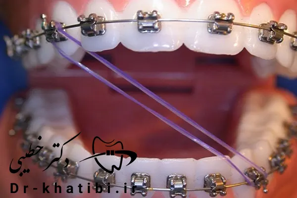 استفاده از کش ارتودنسی