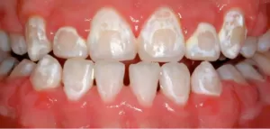 7 عدد از شناخته شده ترین عوارض ارتودنسی دندان