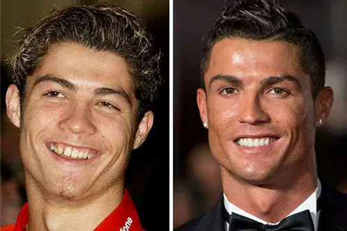 تاثیر ارتودنسی بر بینی