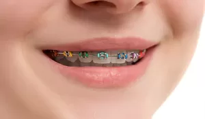 طول درمان ارتودنسی