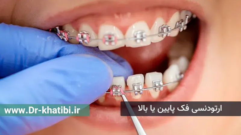 ارتودنسی فک پایین یا بالا