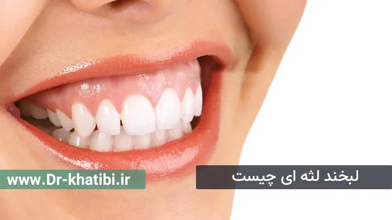 لبخند لثه‌ ای