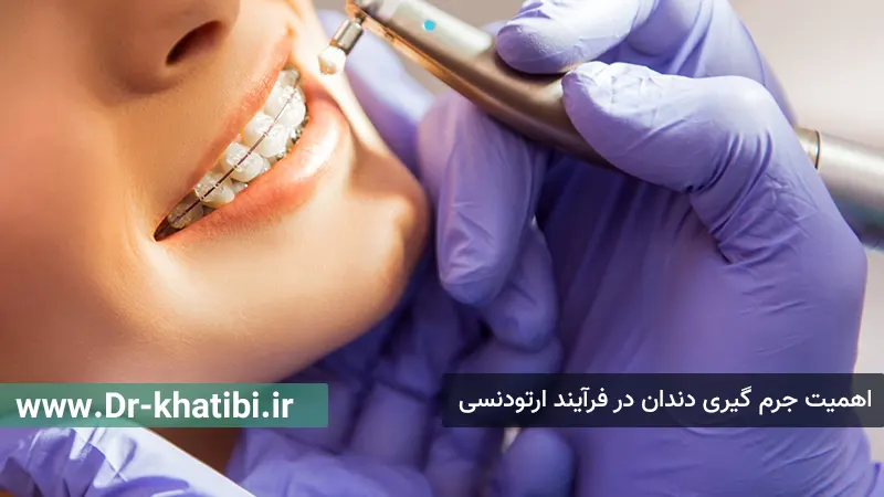 اهمیت جرم گیری دندان در فرآیند ارتودنسی