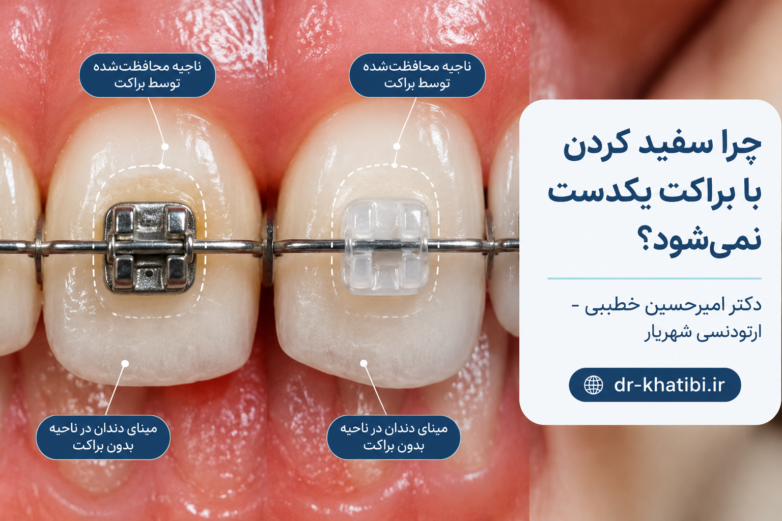 سفید کردن دندان در دوران ارتودنسی؛ بله یا نه؟ | راهنمای دکتر امیرحسین خطیبی